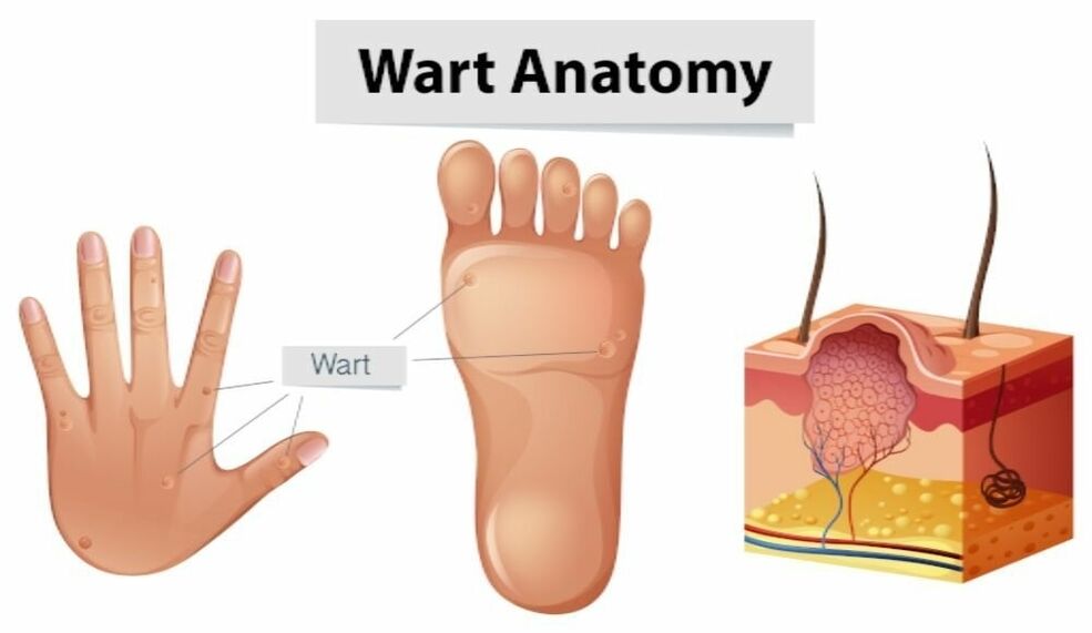 Successful removal of warts along with the root with Removio