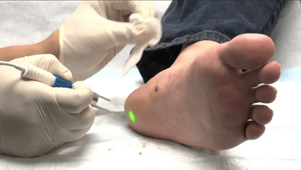 Treatment of planar warts