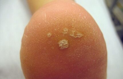 How to recognize a pierce wart