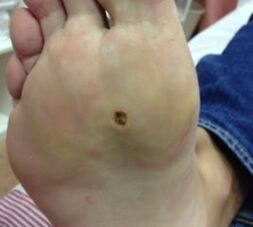 Ways to remove warts on the feet of the legs