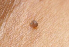 A clinical picture of papilloma