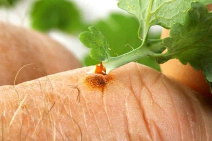 How to remove papillomas with folk medicine