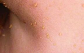 Causes of the appearance of papilloma in the body