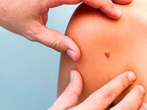 Causes of the appearance of papillomas in the body