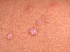 How to get rid of the papillomas of the body