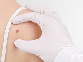 What is the danger of papillomas in the body