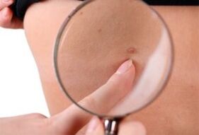 The main causes of papillomas