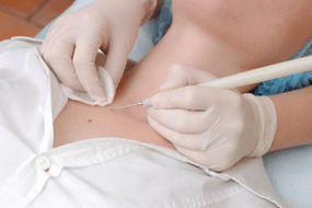 Ways to remove papillomas