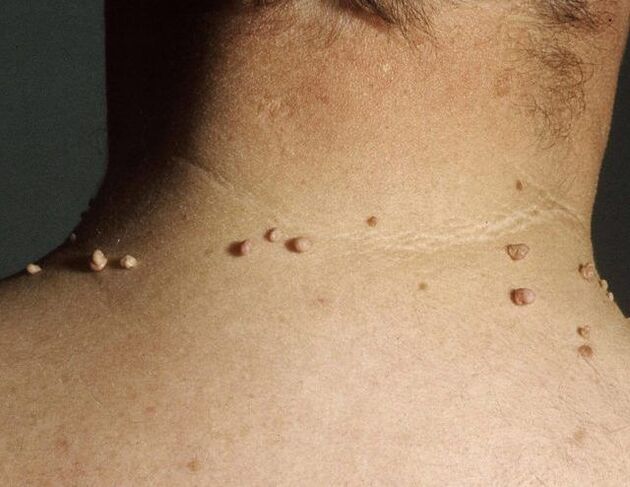Papillomas on the man's neck