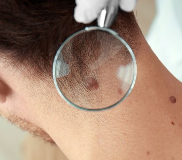 The doctor examines the papilloma on the neck