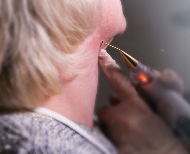 The process of removing a papilloma on a woman's neck