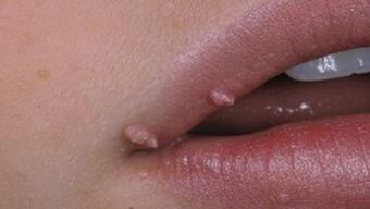 Papillomas on the lips