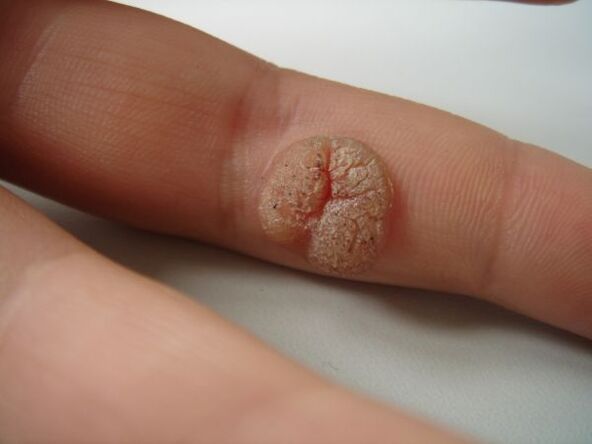 A complication of self-removal of papilloma