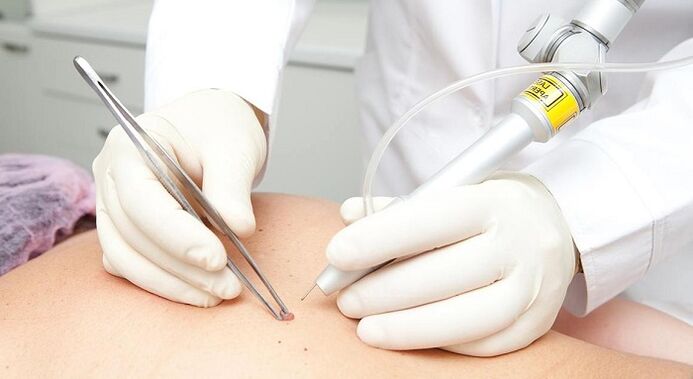 papillomavirus laser removal