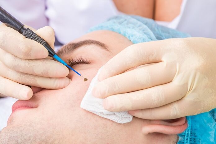 removal of papilloma on the face due to the human papillomavirus