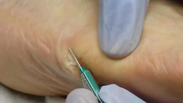 Surgical removal of plantar warts