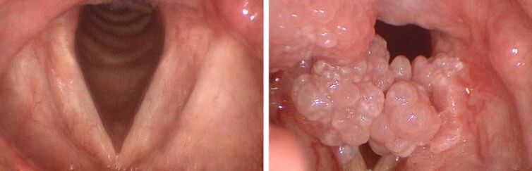 clean throat and papillomas in the pharynx